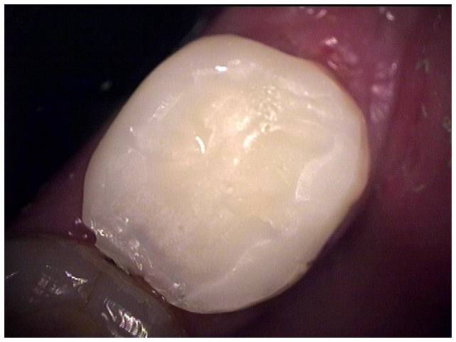 A Ribbond post-orthodontic retainer is a popular alternative to a metal arch wire retainer.